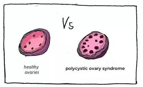 what is Pcos