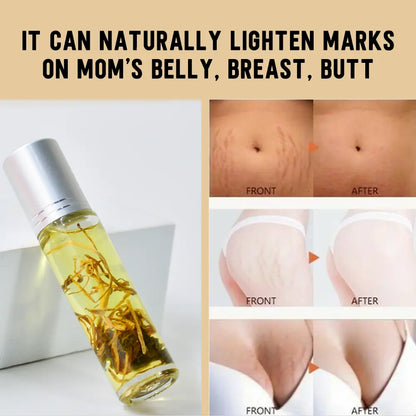 Hiherbs Remove Stretch Marks Oils Pregnancy Scars Maternity Firming Body Oils (10ml*2) Sold from 2 bottles Hiherbs